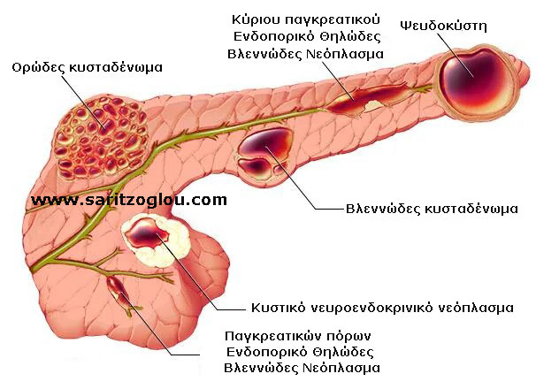 Κύστη παγκρέατος